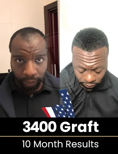 5100 Graft Hair Transplant Result after 2 years