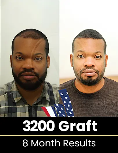4750 Graft Hair Transplant Result after 1 year