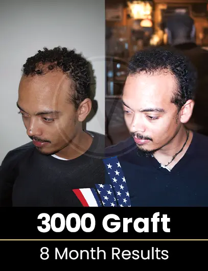 4500 Graft Hair Transplant Result after 1 year