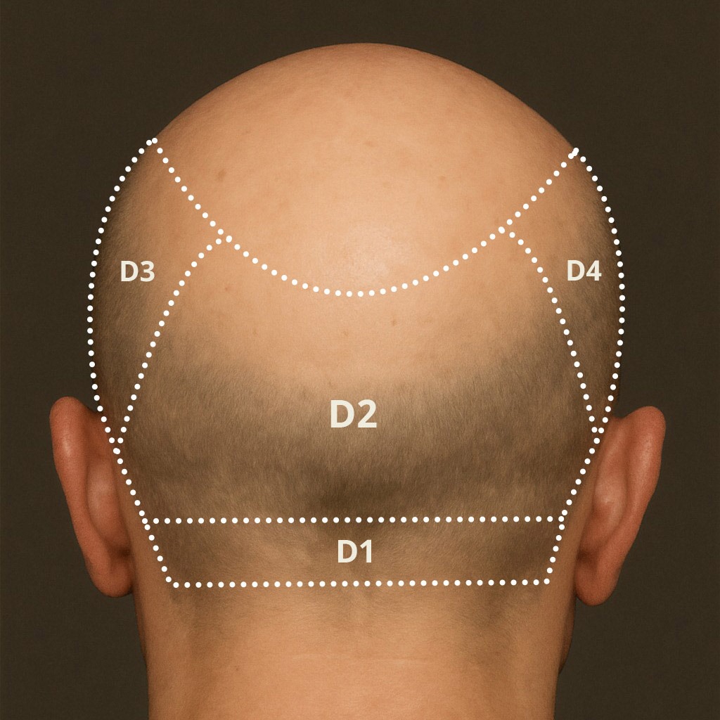 Vue Arrière des Zones de Greffe de Cheveux - Zones Donneuses D1, D2, D3, D4