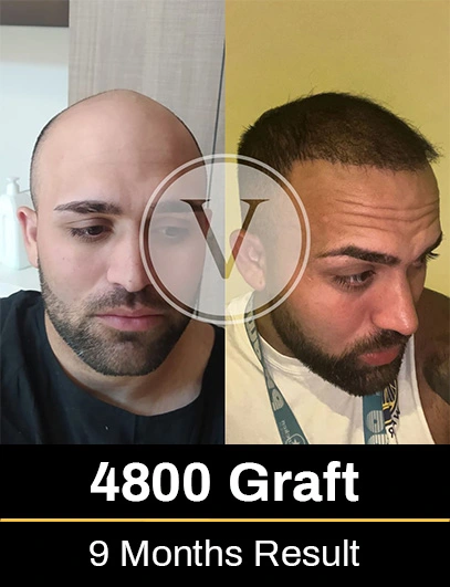 4800 Graft Hair Transplant Result after 9 months