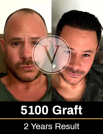 5100 Graft Hair Transplant Result after 2 years