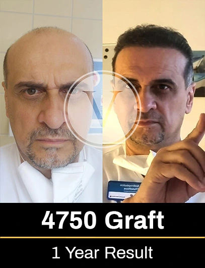 4750 Graft Hair Transplant Result after 1 year