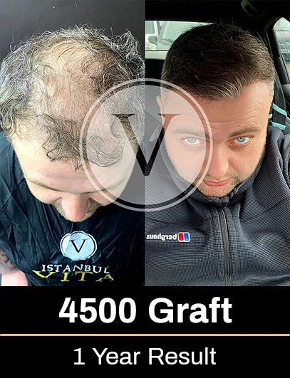 4500 Graft Hair Transplant Result after 1 year