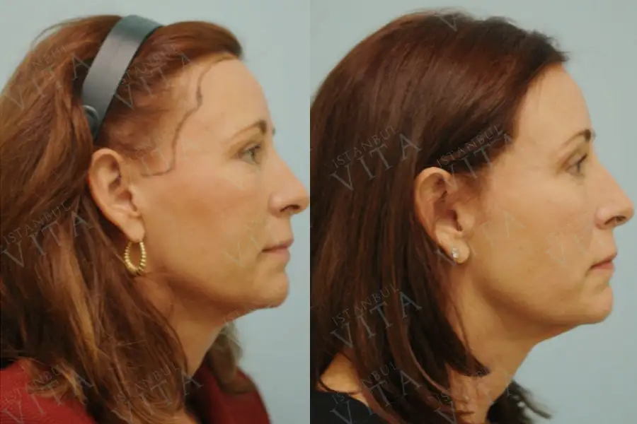 Women hair transplant before and after