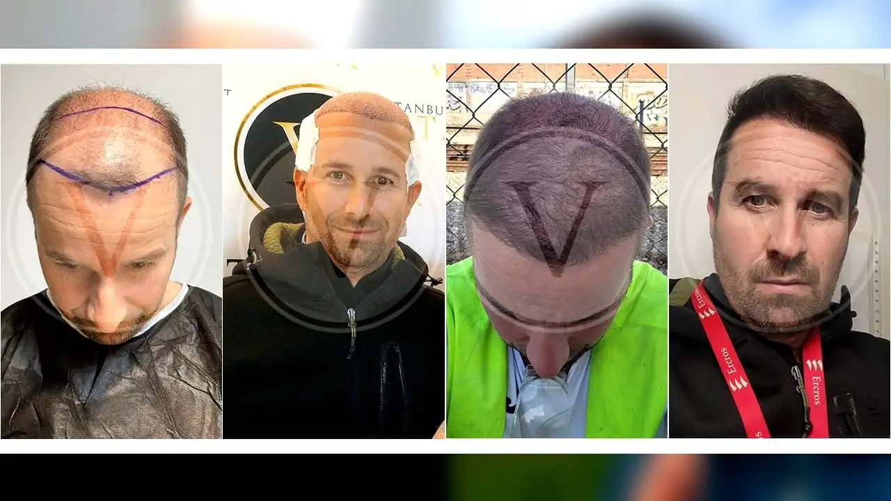 Hair transplant Before and After Istanbul Vita