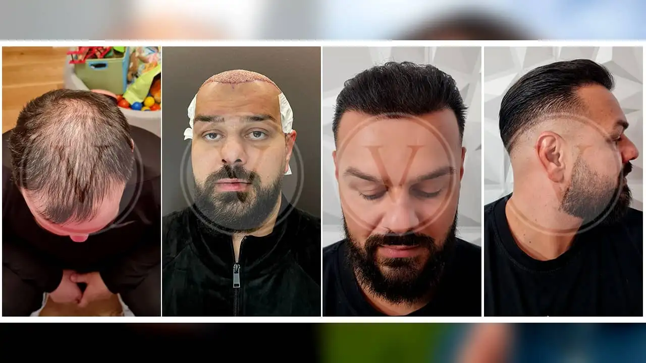 Hair transplant Before and After Istanbul Vita
