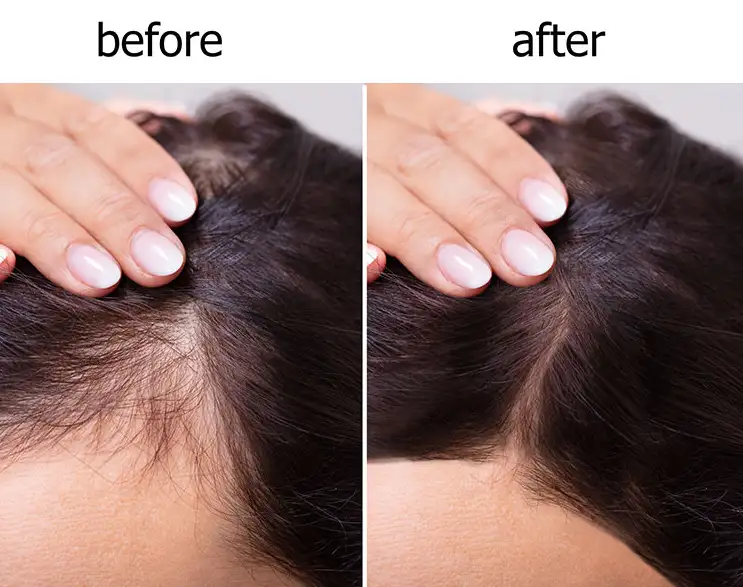 Hair Transplant Women Before and After