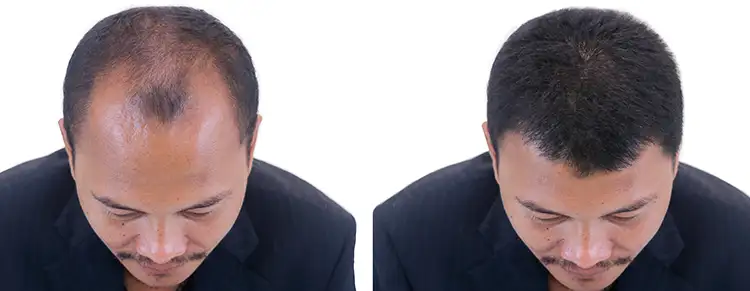 DHI hair transplant before and after