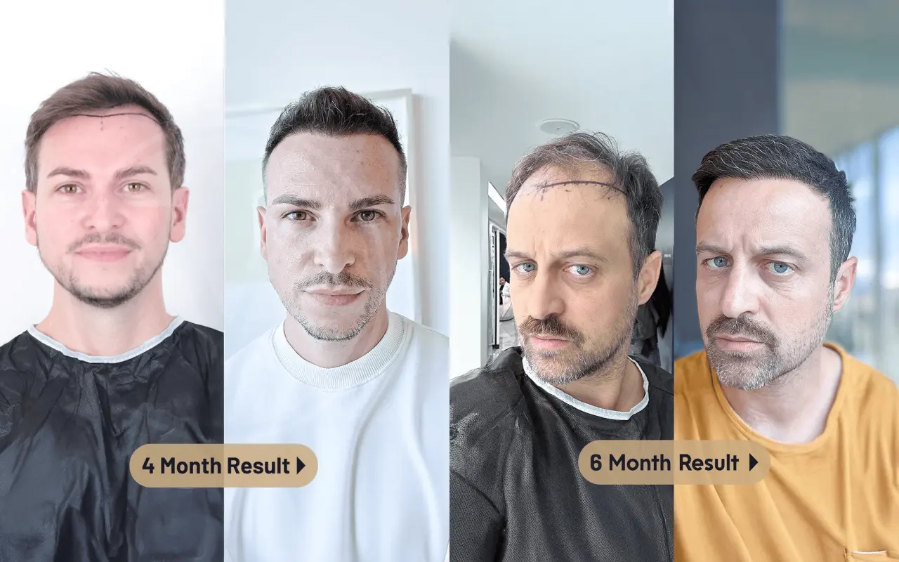 Tehnica Vita Implant de Păr before after