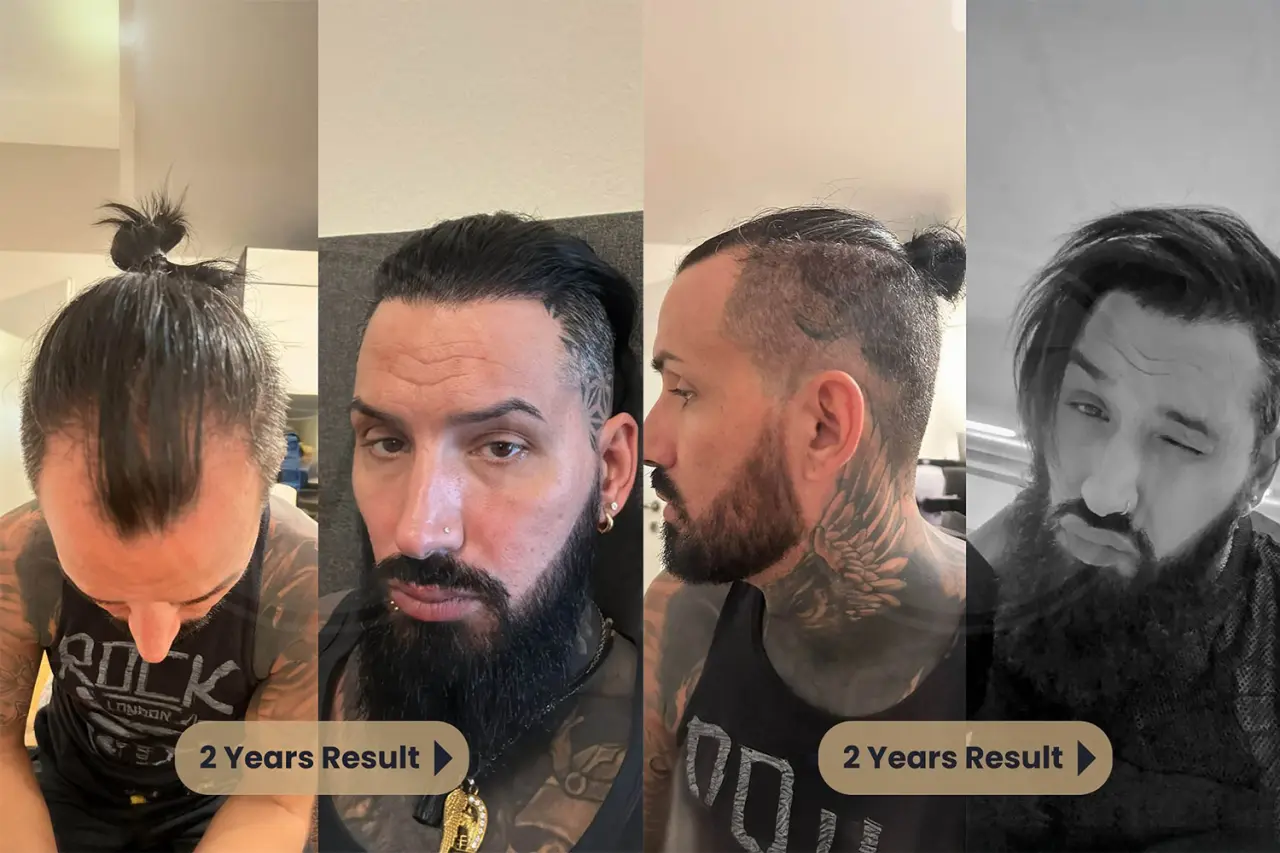 Long Hair Fue Transplant