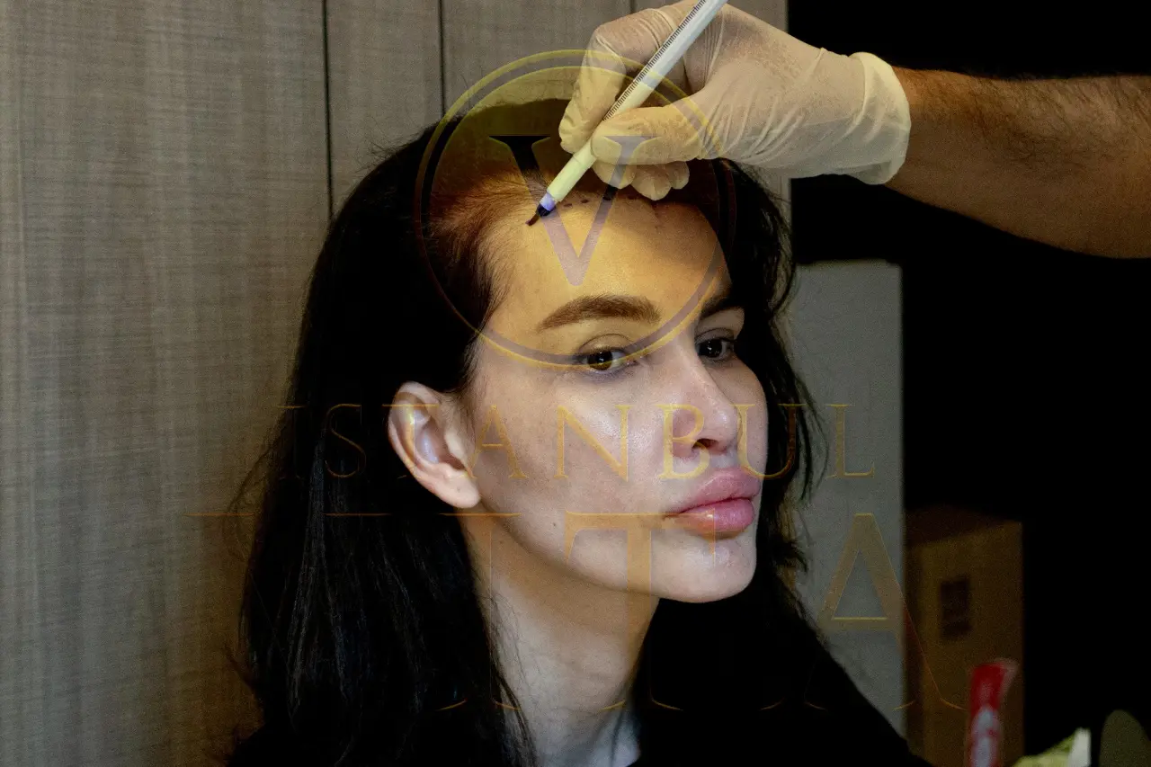 Haartransplantation für Frauen