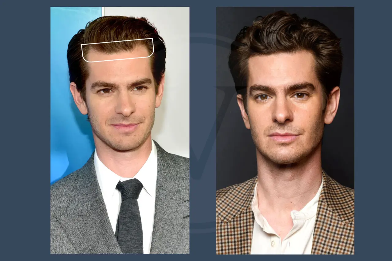 Celebrity Hair Transplant Andrew Garfield
