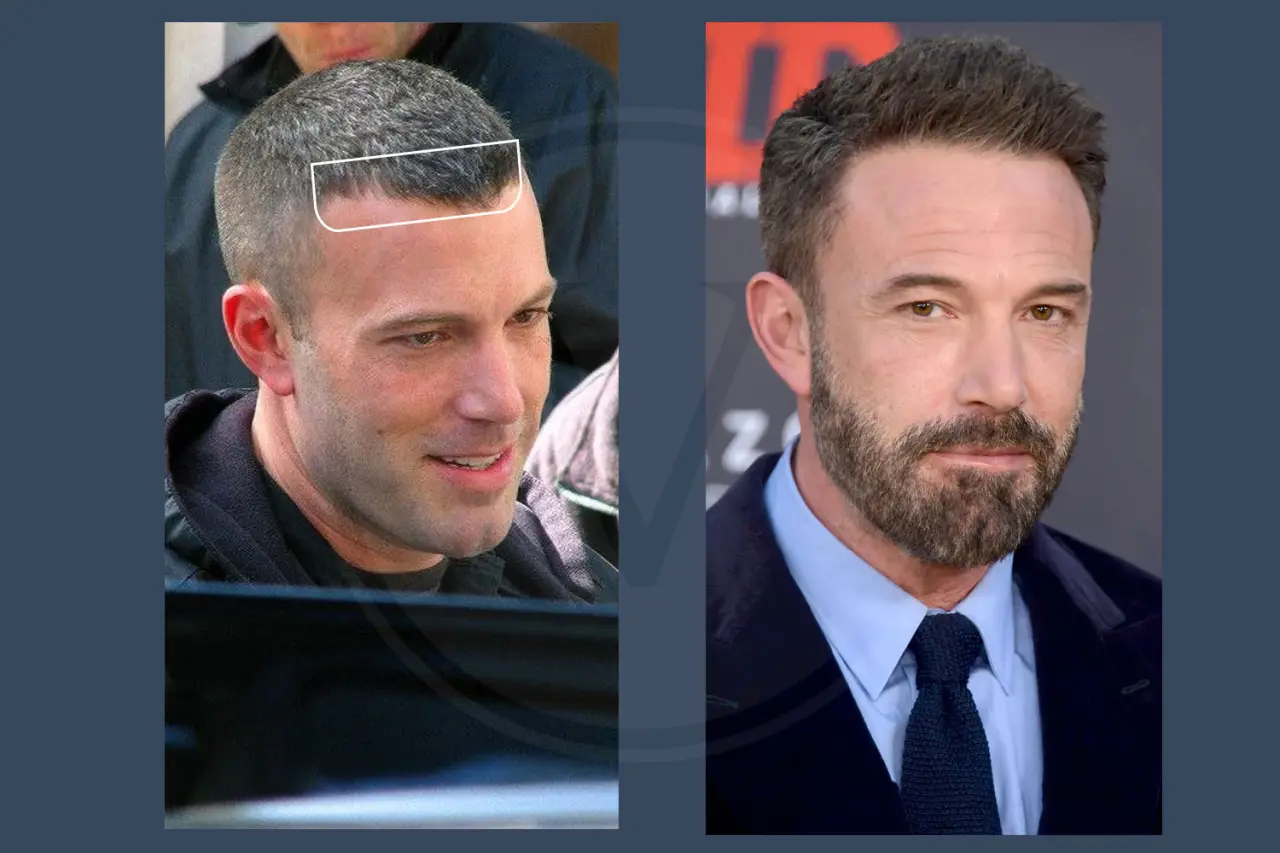 Celebrity Hair Transplant Ben Affleck