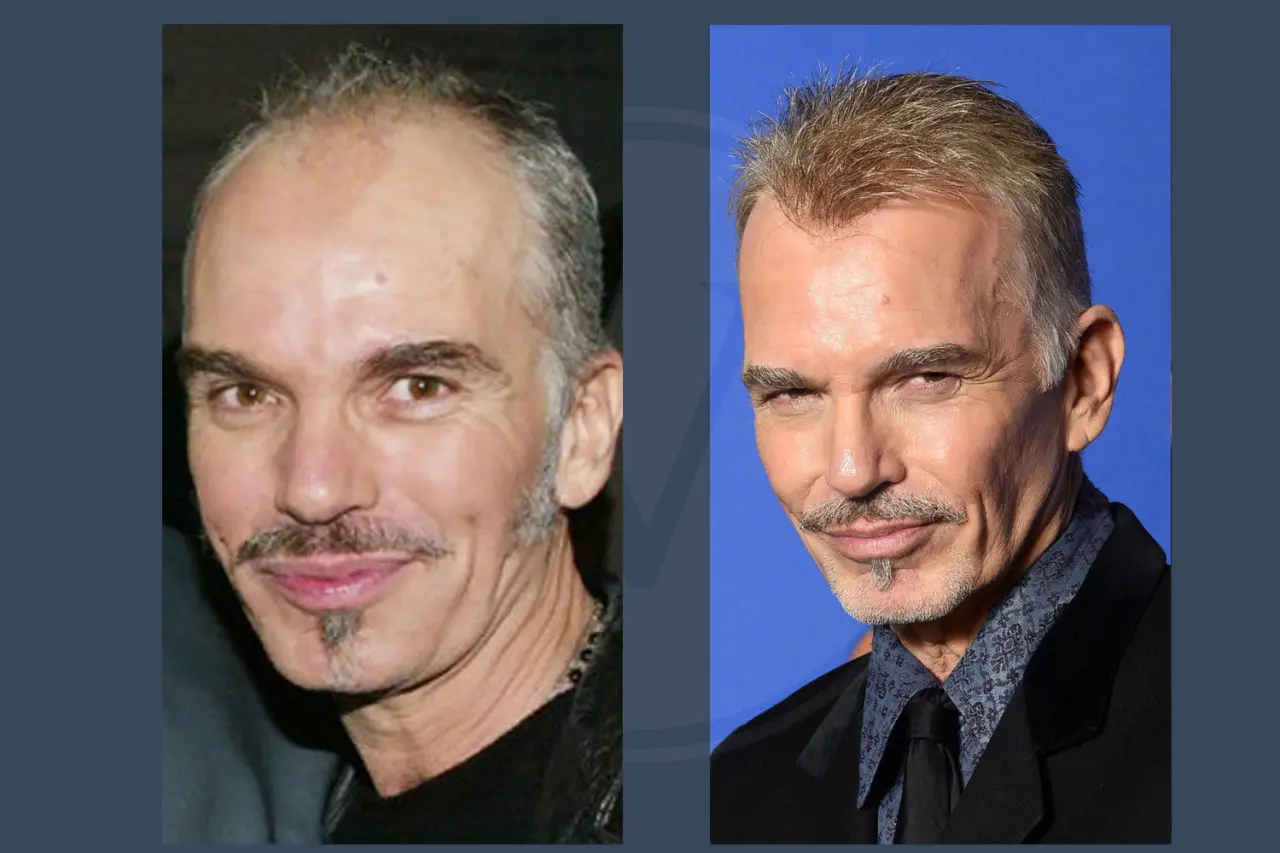 Celebrity Hair Transplant Billy Bob Thornton