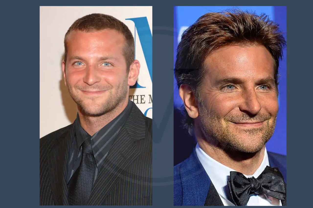 Celebrity Hair Transplant Bradley Cooper