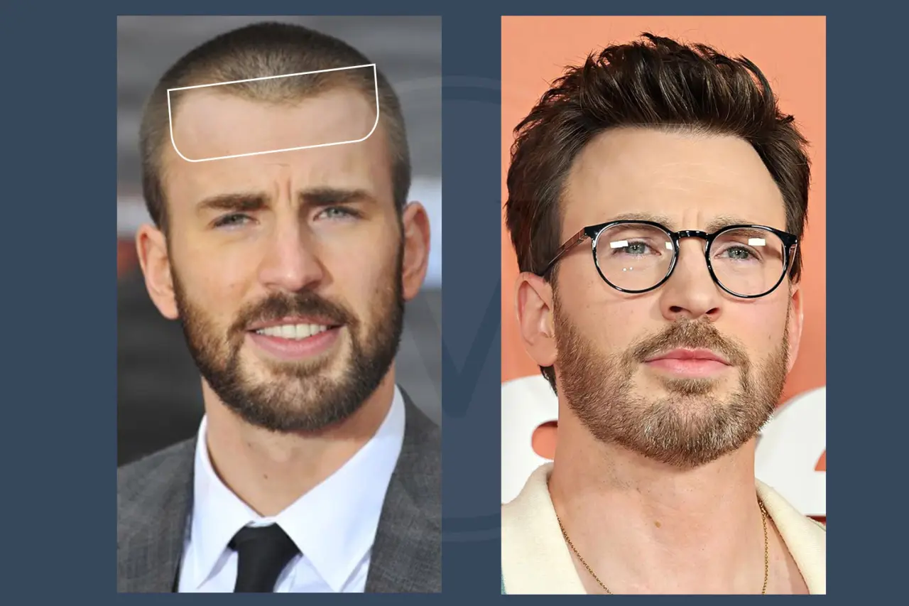 Celebrity Hair Transplant Chris Evans