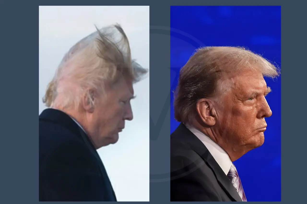 Celebrity Hair Transplant Donald Trump