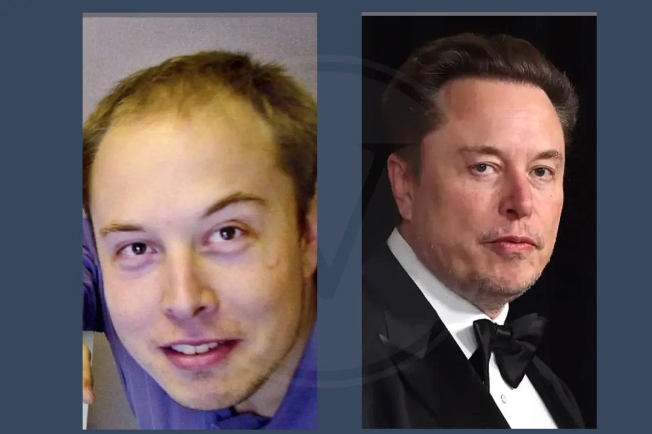 Celebrity Hair Transplant Elon Musk