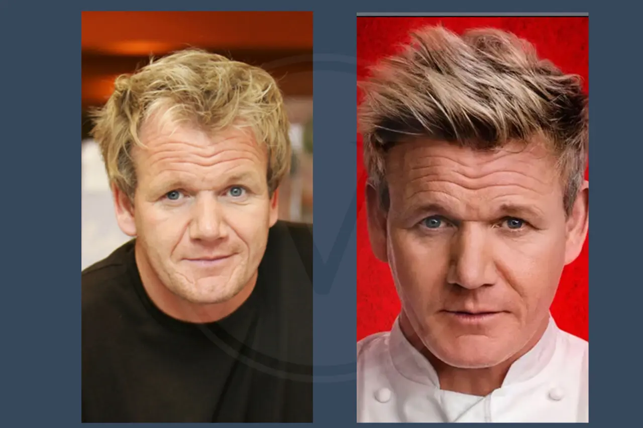 Celebrity Hair Transplant Gordon Ramsey