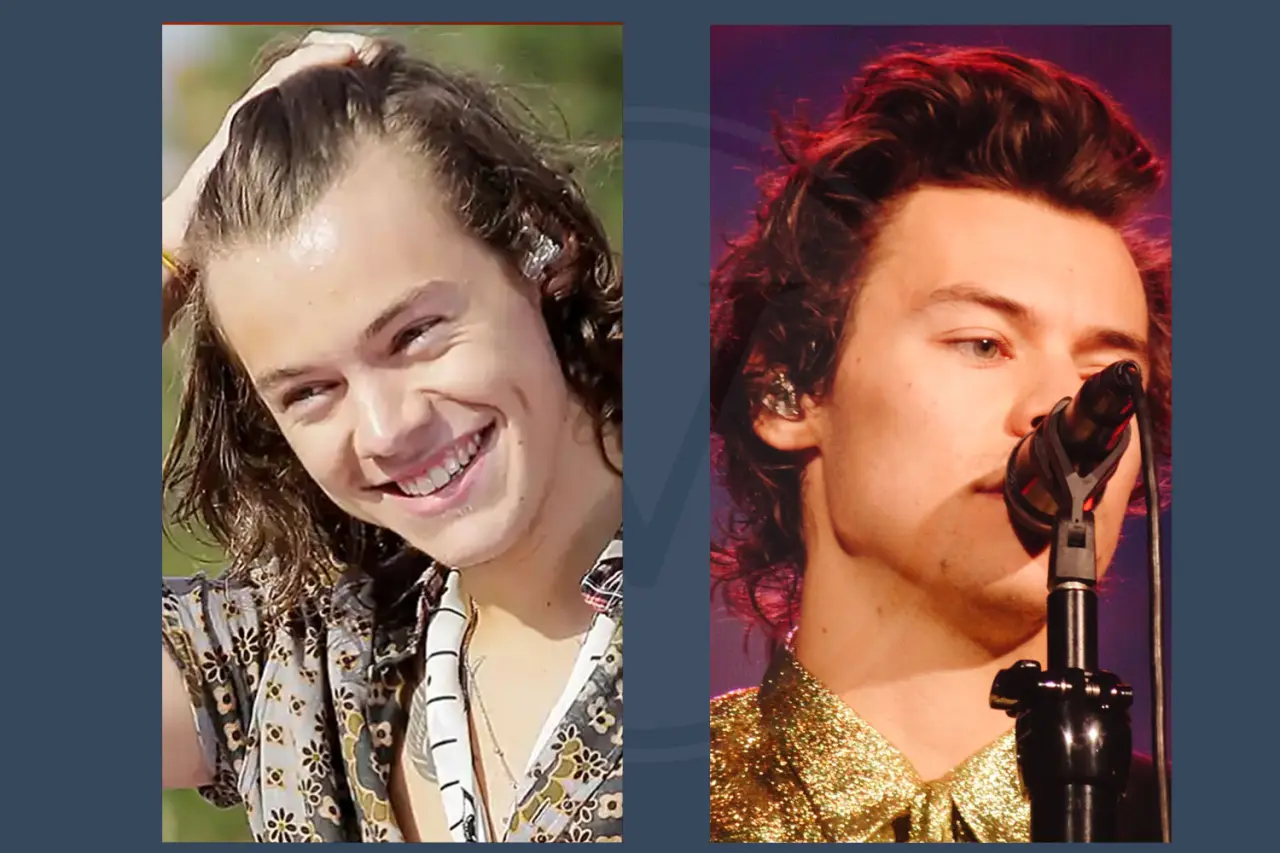 Celebrity Hair Transplant Harry Styles