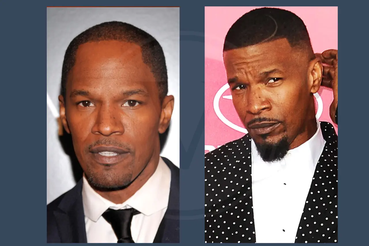 Celebrity Hair Transplant Jamie Foxx