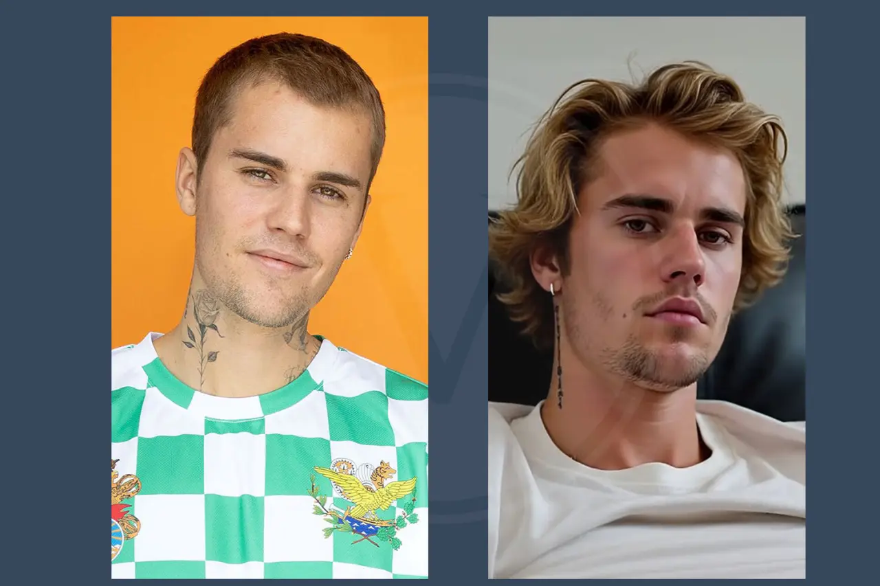 Celebrity Hair Transplant Justin Bieber