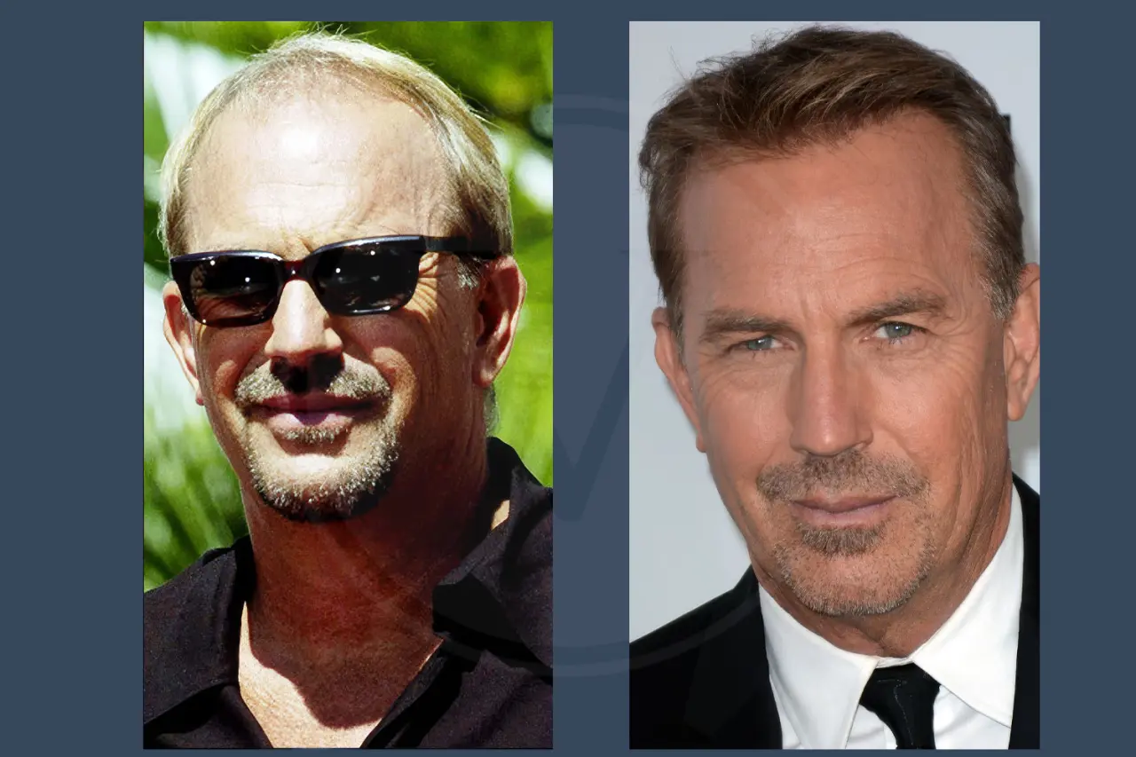 Celebrity Hair Transplant Kevin Costner