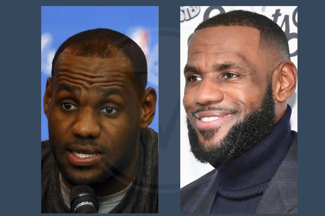 Celebrity Hair Transplant Lebron James