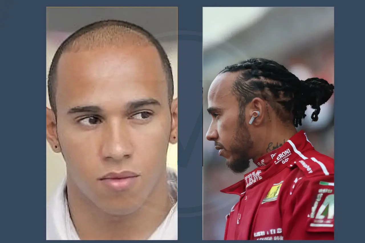 Celebrity Hair Transplant Lewis Hamilton