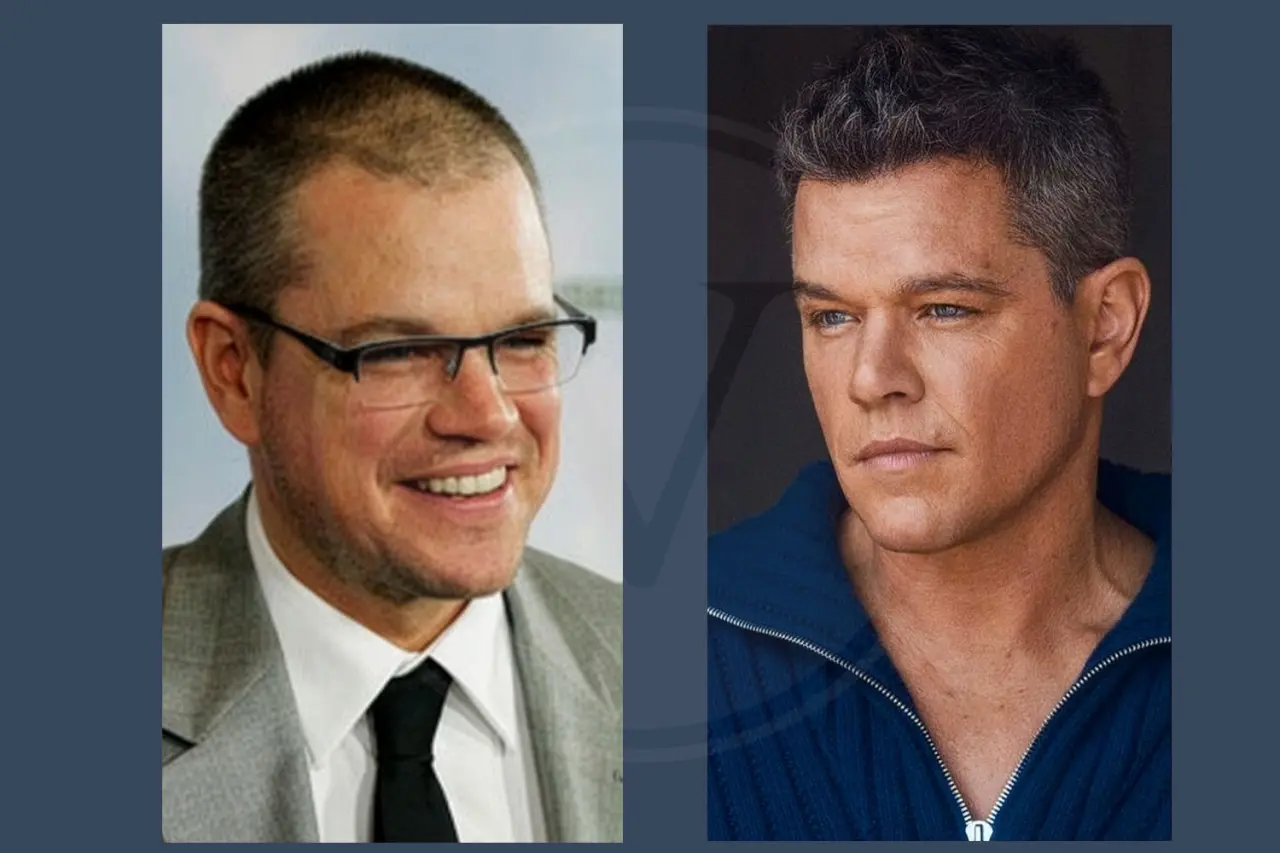 Celebrity Hair Transplant Matt Damon