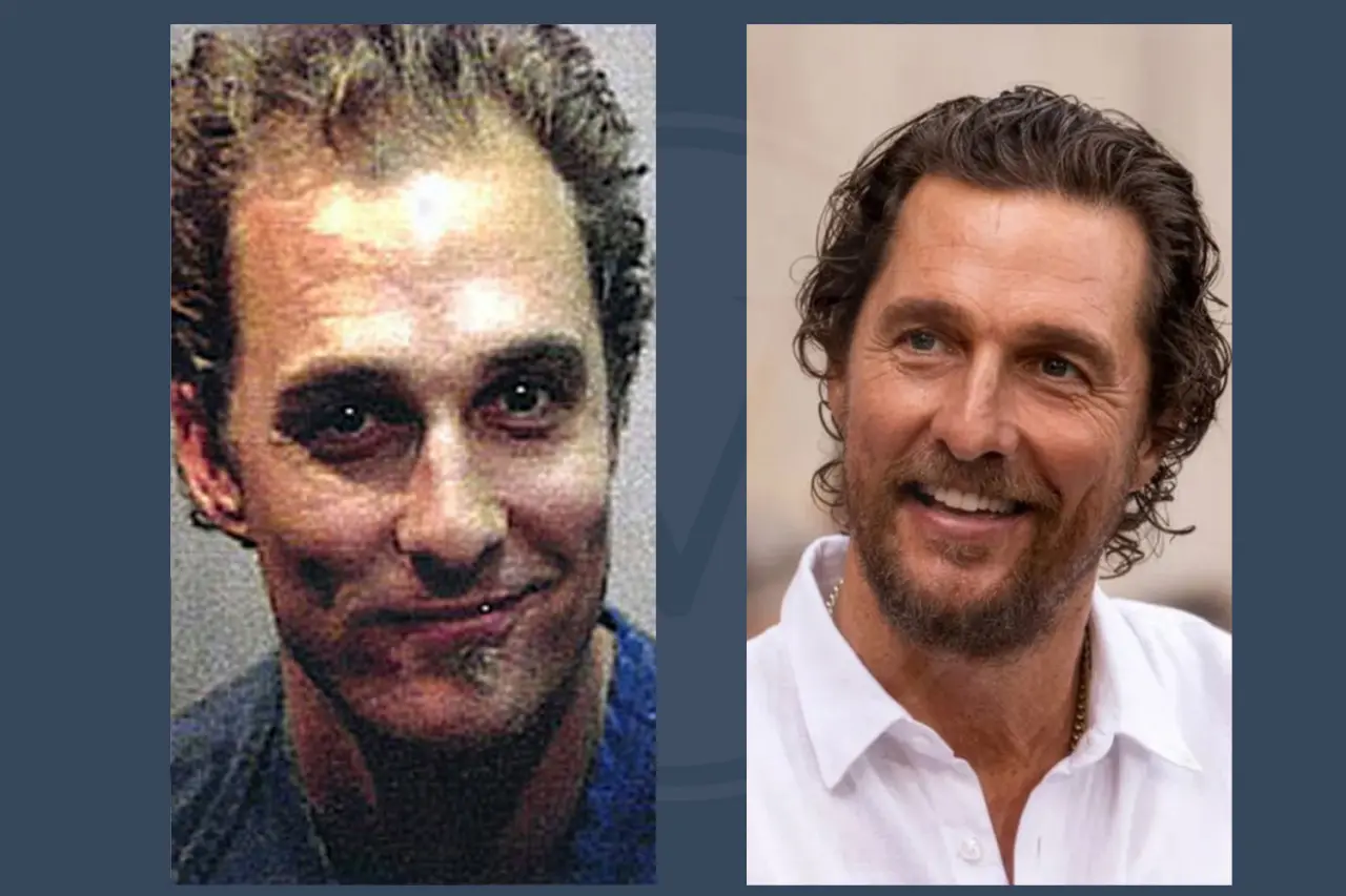 Celebrity Hair Transplant Matthew Mcconaughey