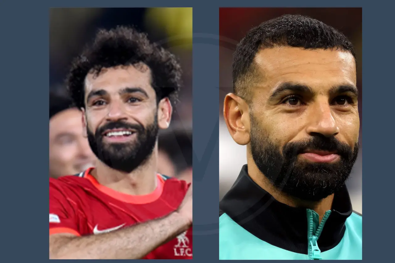 Celebrity Hair Transplant Mohammed Salah