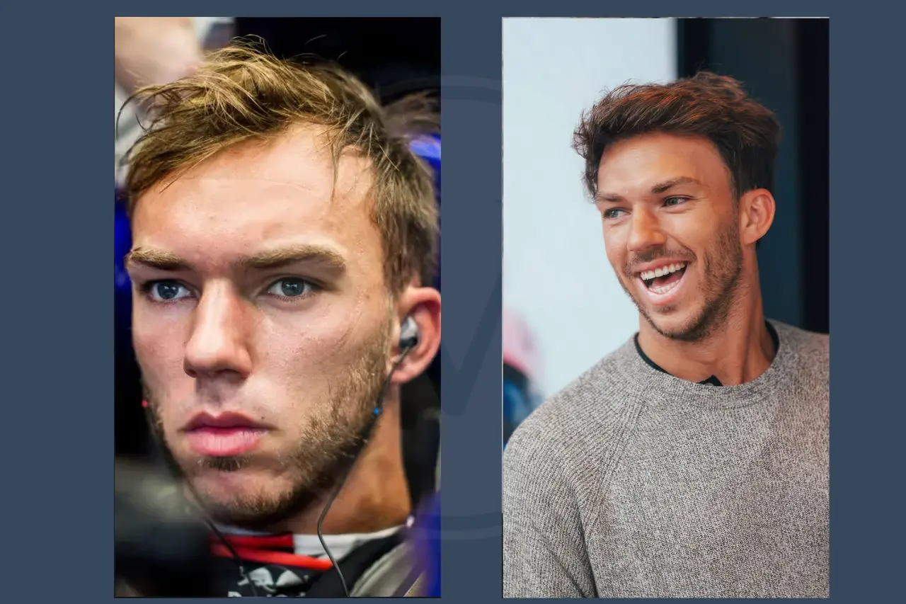 Celebrity Hair Transplant Pierre Gasly
