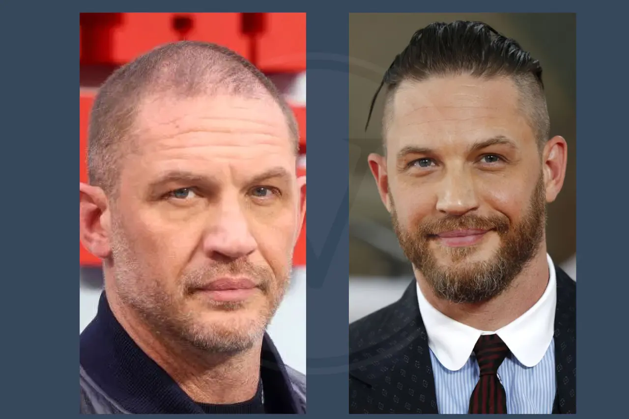 Celebrity Hair Transplant Tom Hardy