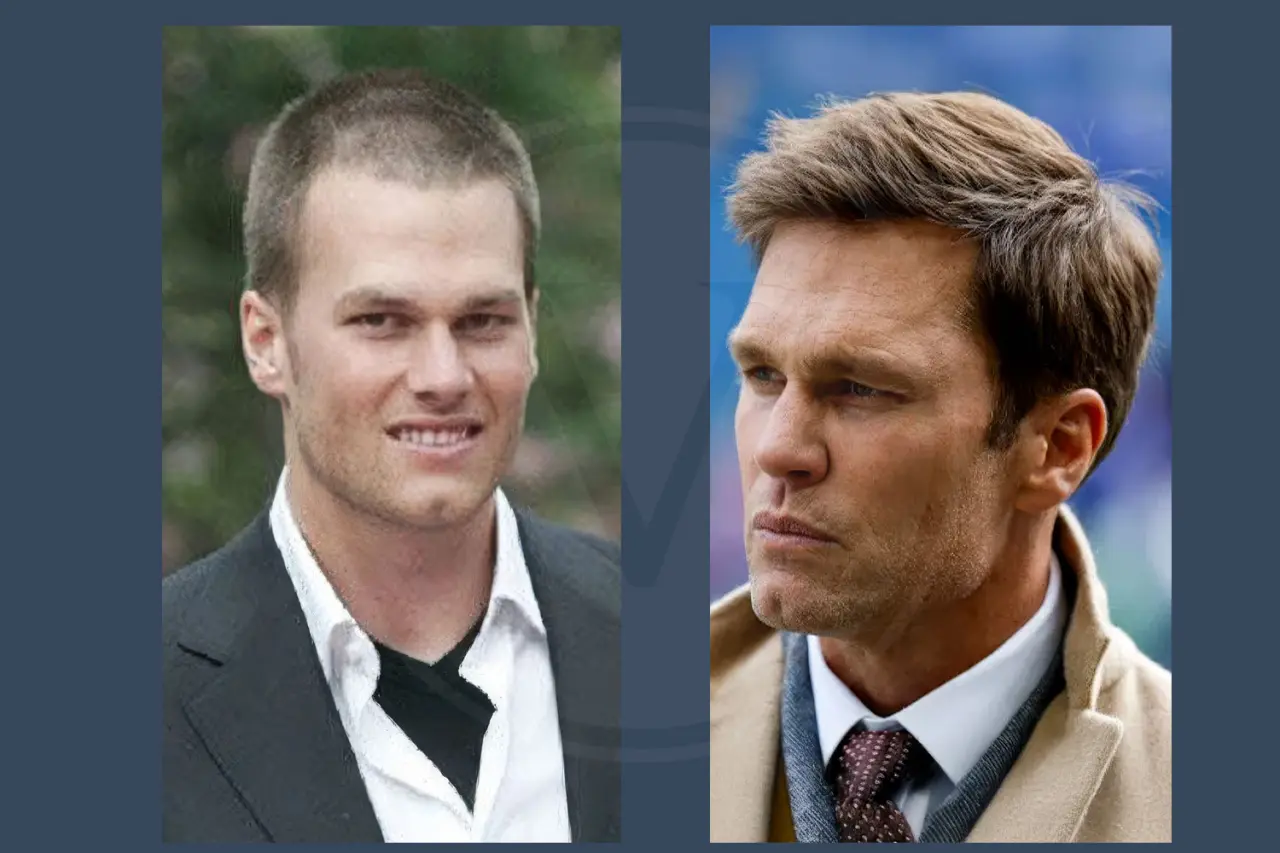 Celebrity Hair Transplant Tom Brady