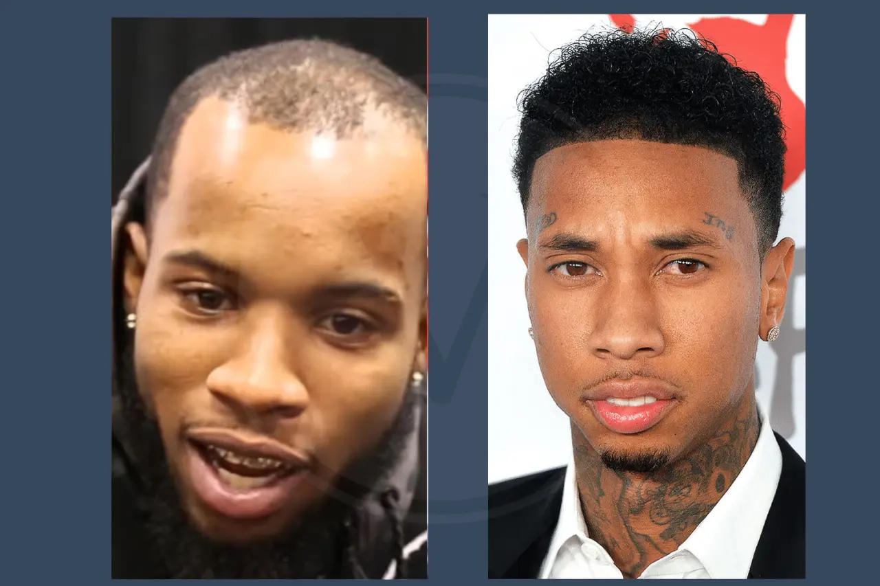 Celebrity Hair Transplant Tyga