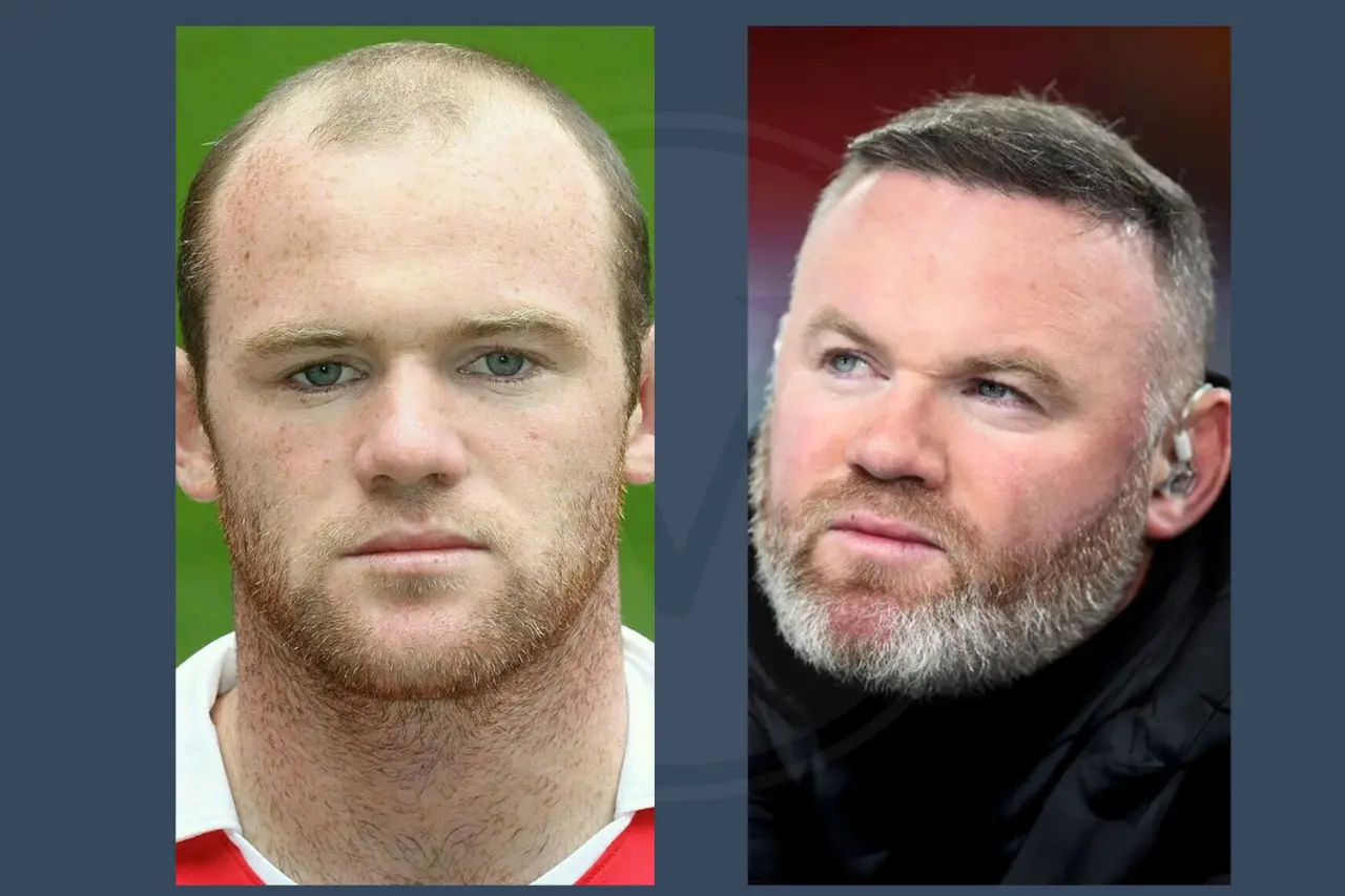 Celebrity Hair Transplant Wayne Ronney