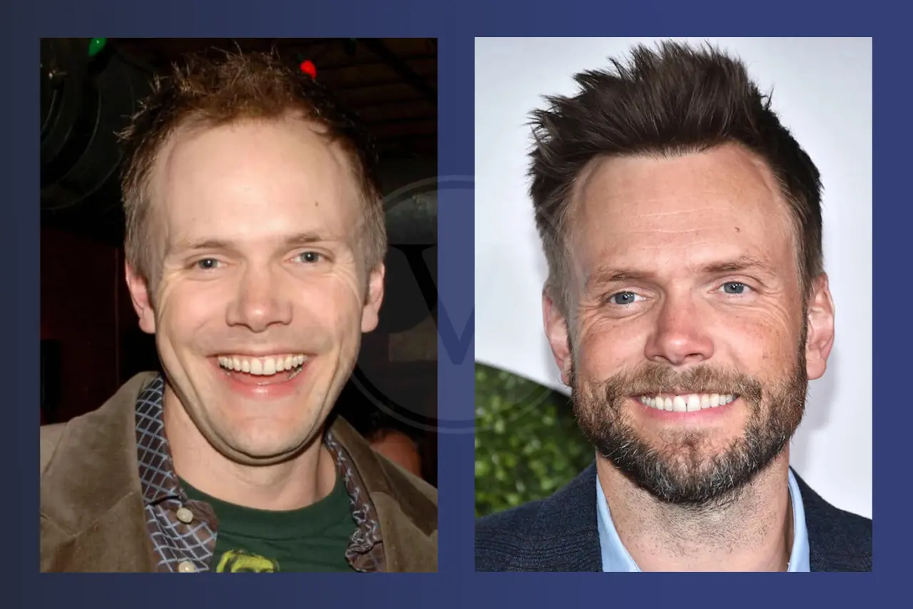 Joel McHale Before and After Hair Transplant