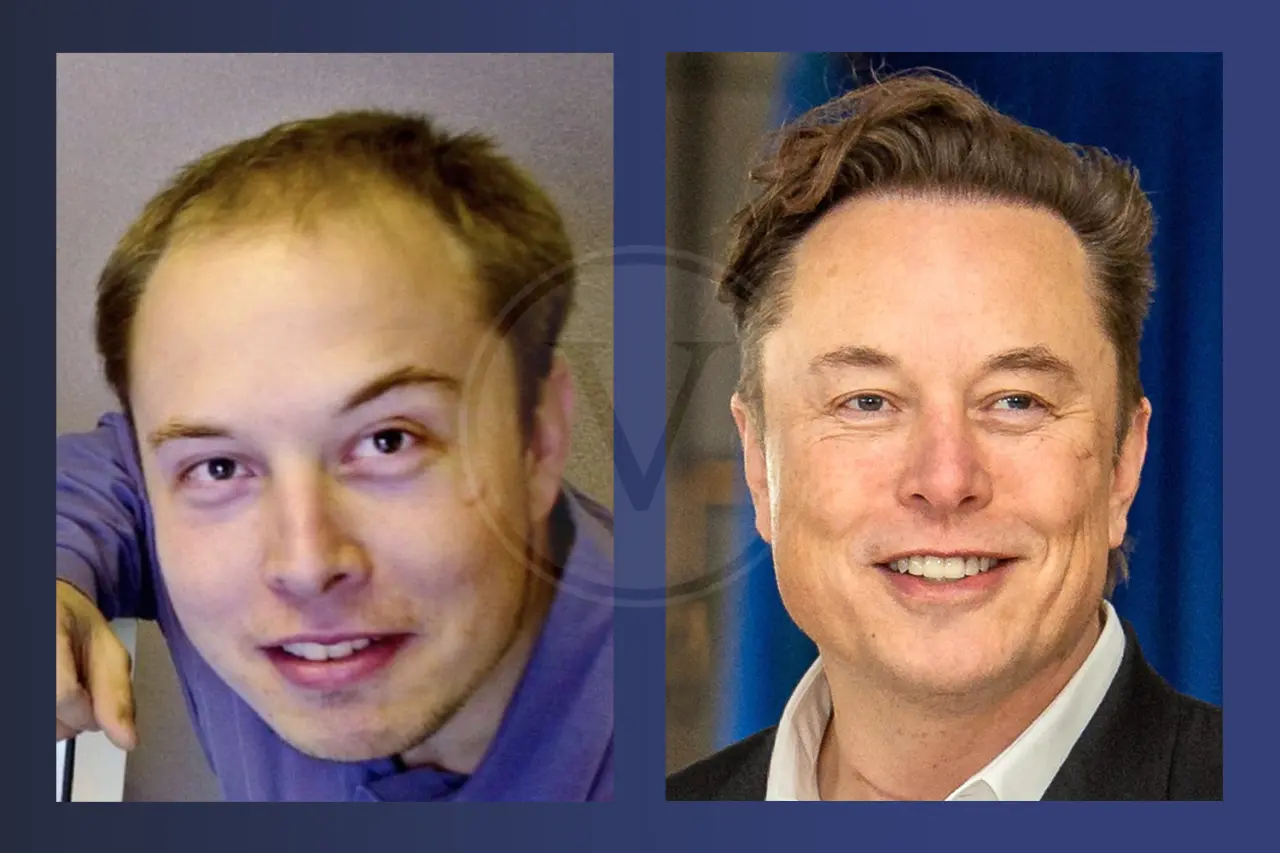 Elon Musk Before and After Hair Transplant