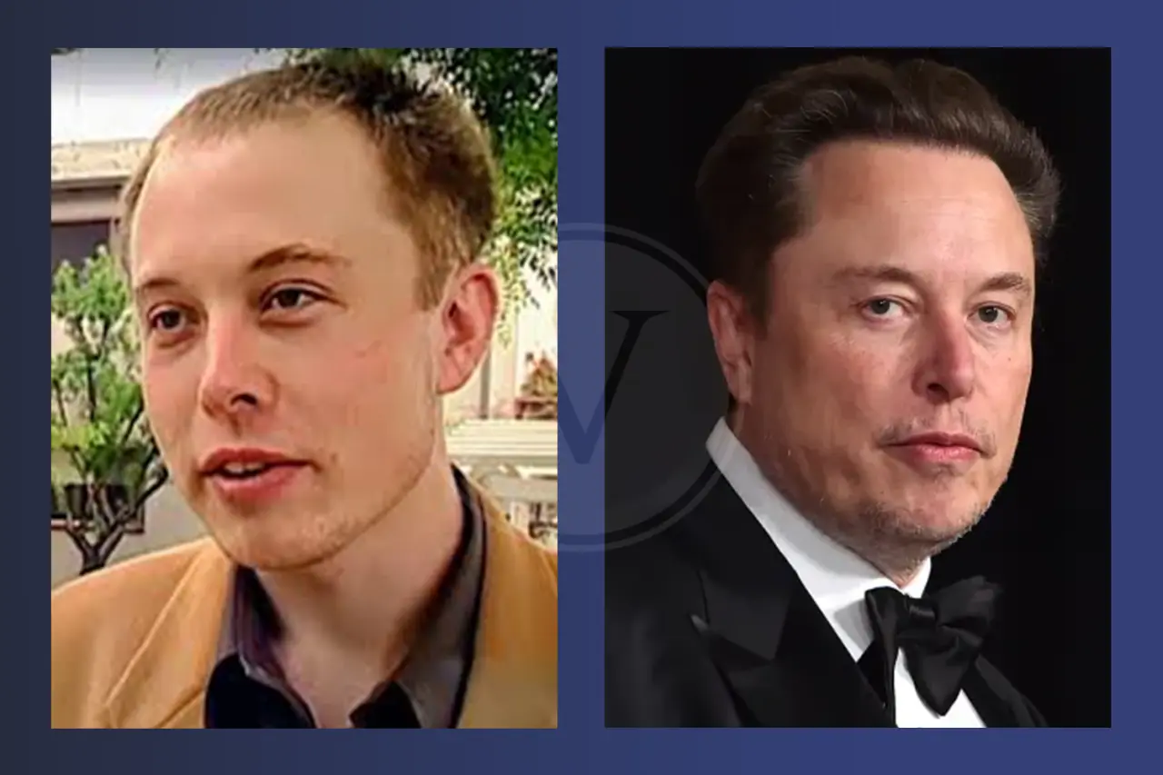Elon Musk Before and After Hair Transplant