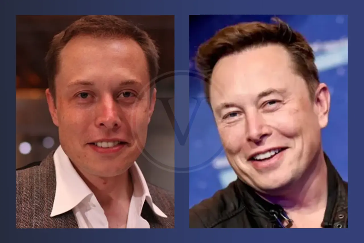 Elon Musk Before and After Hair Transplant