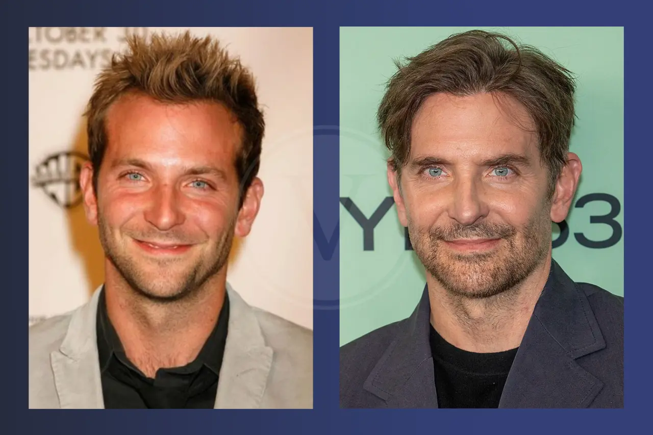 Bradley Cooper Before and After Hair Transplant