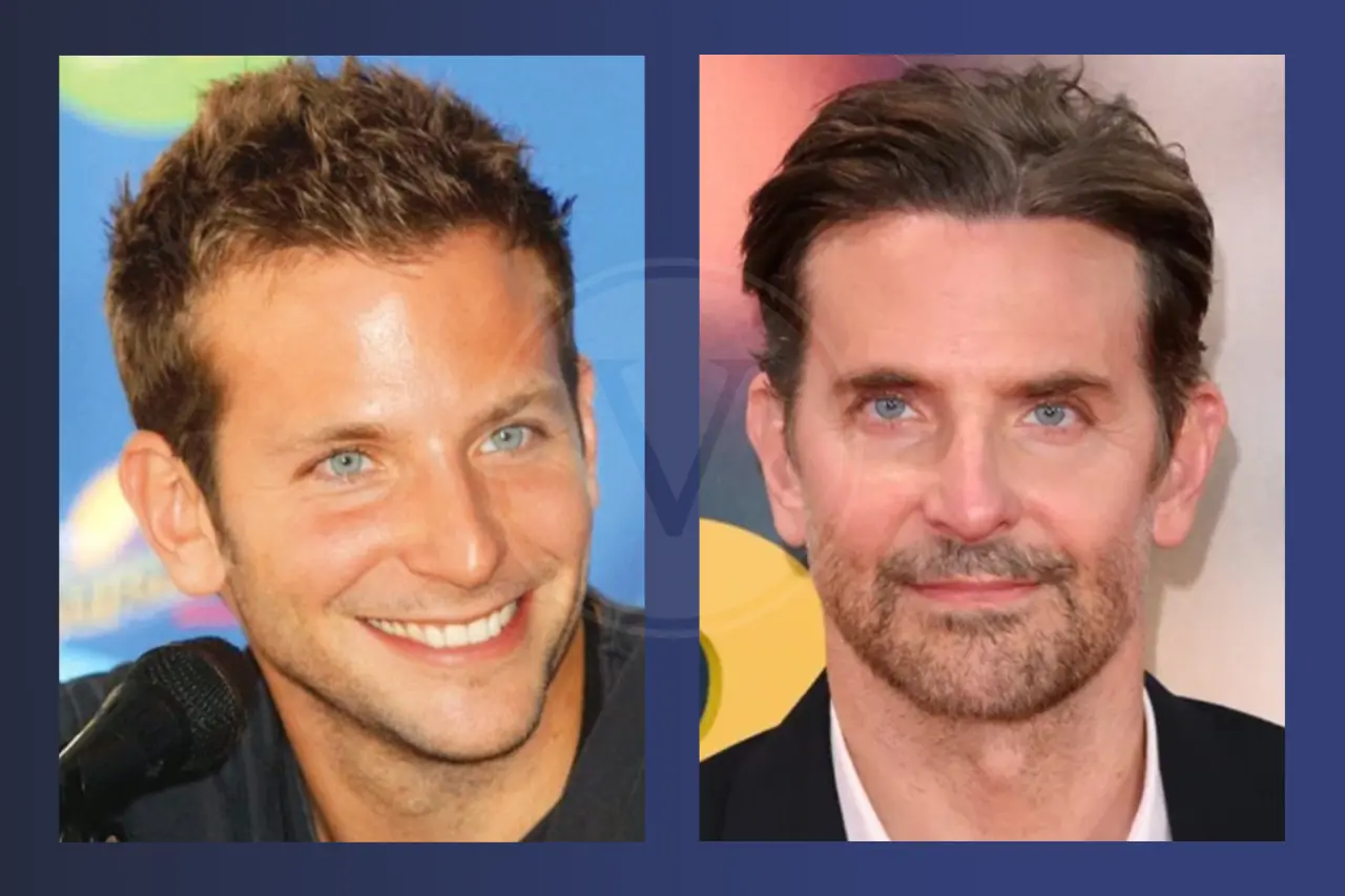 Bradley Cooper Before and After Hair Transplant