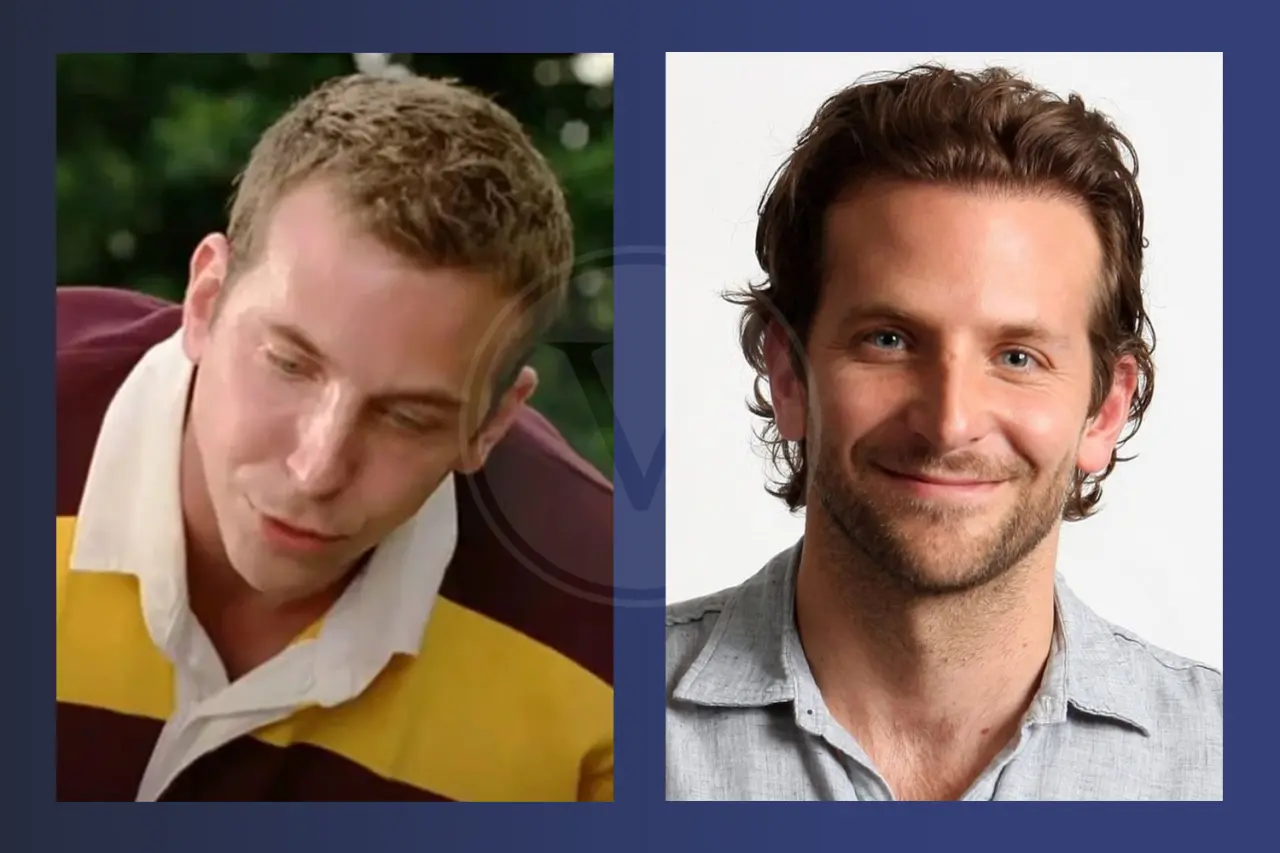 Bradley Cooper Before and After Hair Transplant