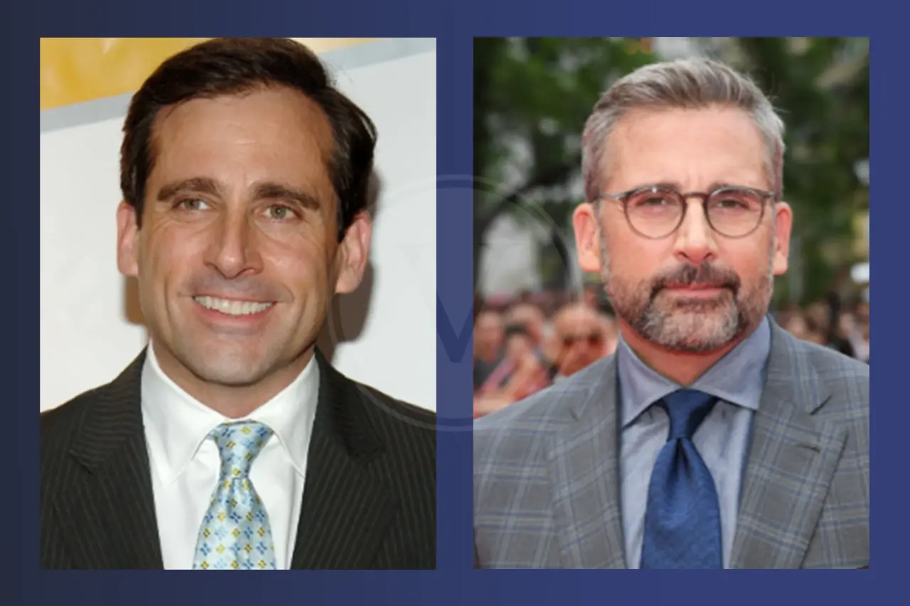Steve Carell Before and After Hair Transplant