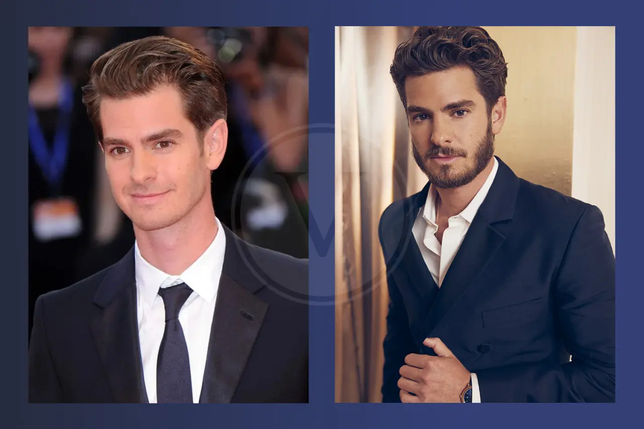 Andrew Garfield Before And After Hair Transplant