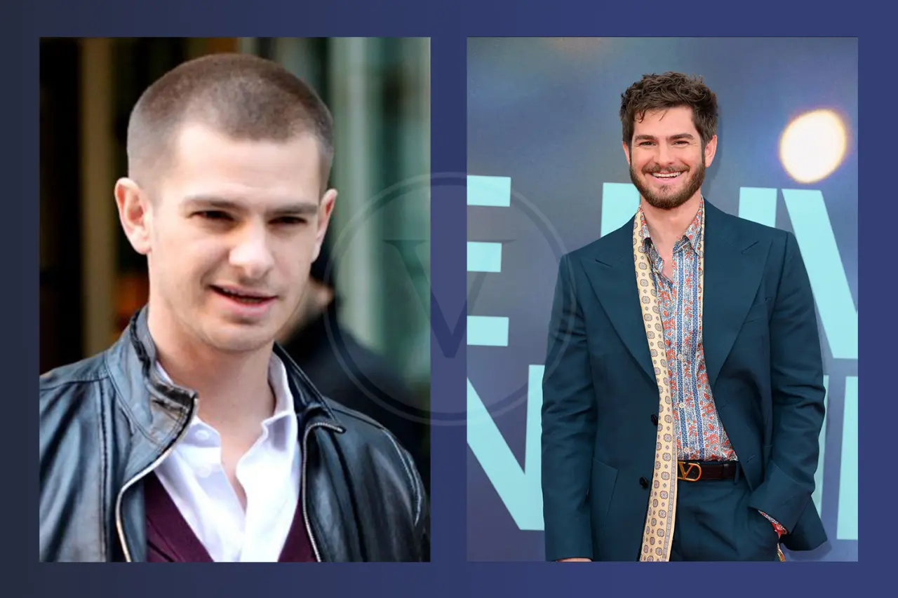 Andrew Garfield Before And After Hair Transplant