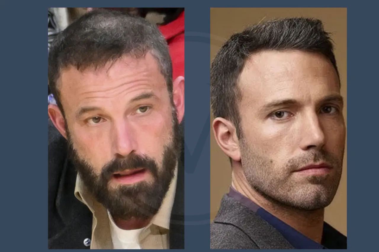 Ben Affleck Before and After Hair Transplant