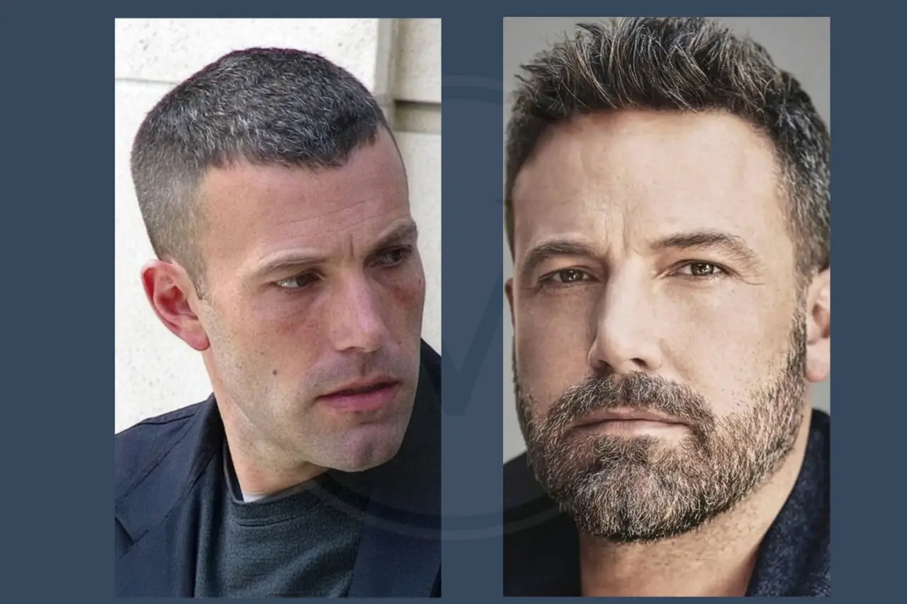 Ben Affleck Before and After Hair Transplant
